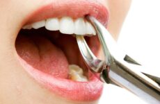 Що робити після видалення зуба: рекомендації по догляду за порожниною рота