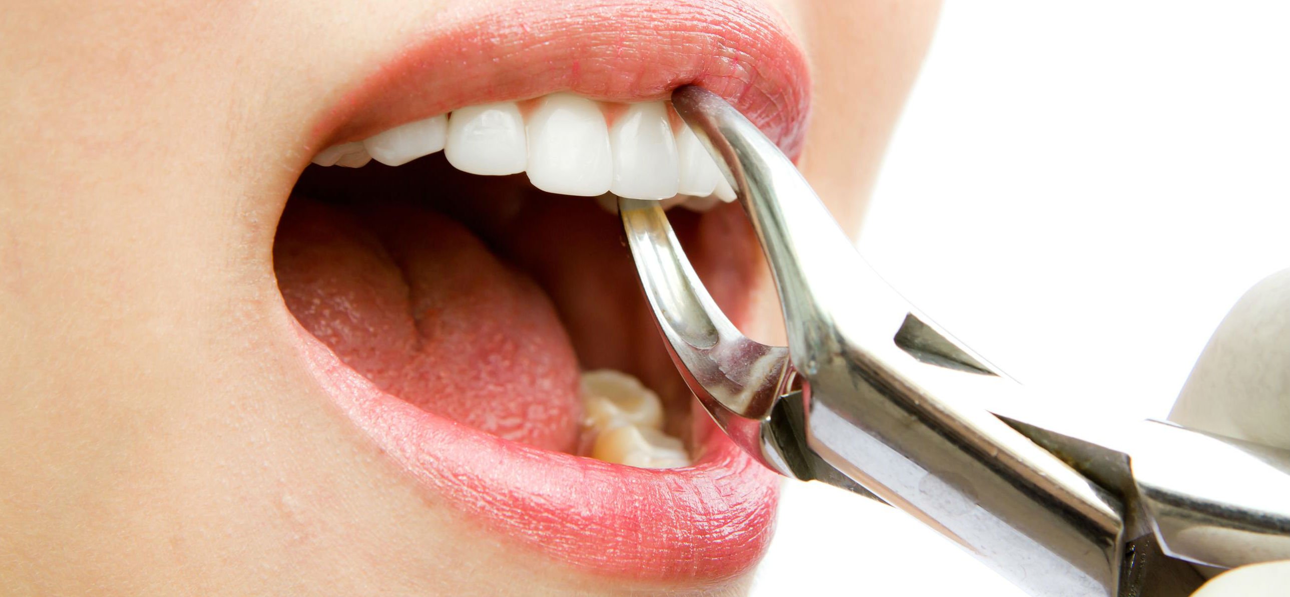 Що робити після видалення зуба: рекомендації по догляду за порожниною рота