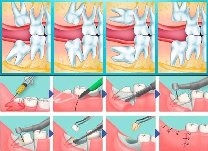 Сверхкомплектные зуби або гіпердонтія   причини виникнення і лікування