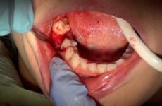 Скільки тримати тампон після видалення зуба: рекомендації лікарів