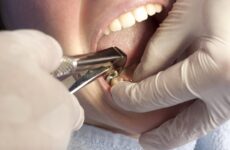 Чому не заростає лунку після видалення зуба: причини, що робити?