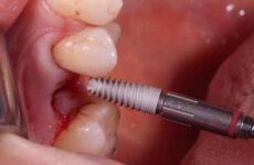 Ускладнення після видалення зубів – причини появи та лікування