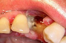 Після видалення зуба стирчить кістка з десни – причини і видалення дефекту