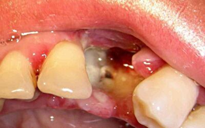 Після видалення зуба стирчить кістка з десни – причини і видалення дефекту