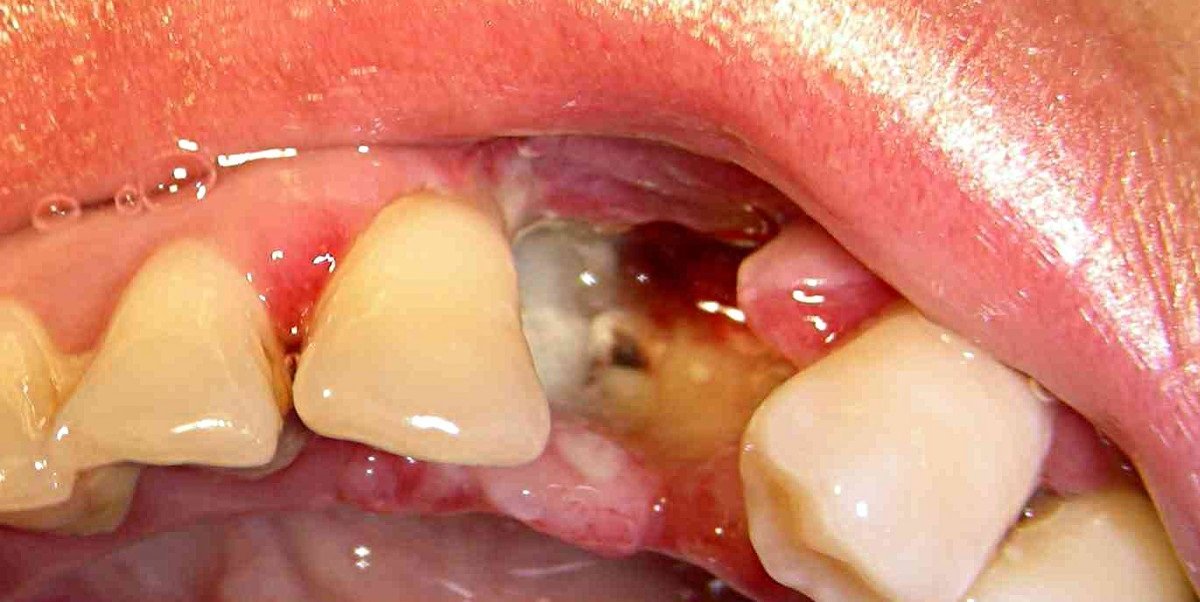 Після видалення зуба стирчить кістка з десни   причини і видалення дефекту
