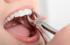 Видалення зуба: як відбувається процес екстракції зуба у стоматології