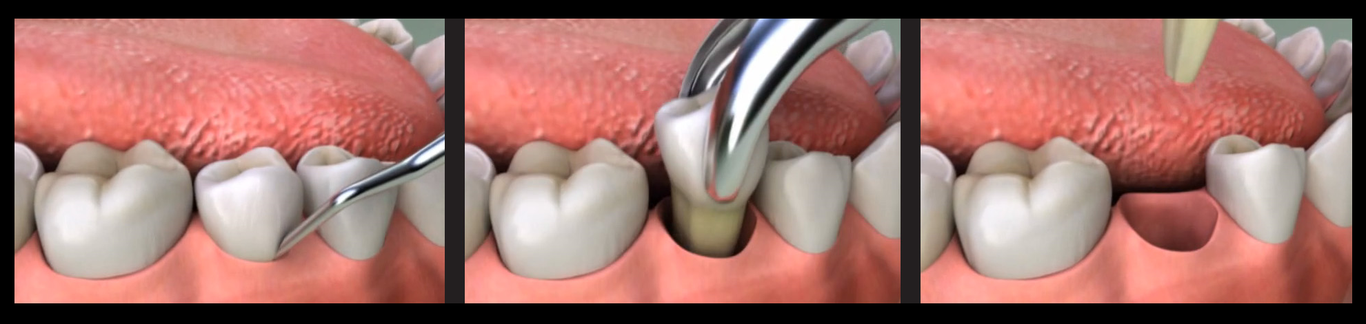 Скільки зубів можна видалити за один раз: особливості процедури