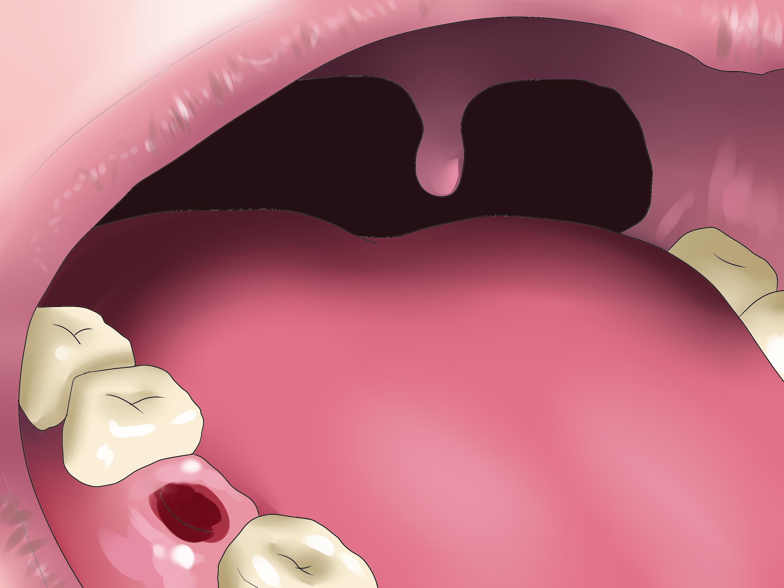 Альвеоліт після видалення зуба: причини, симптоми і лікування сухої лунки
