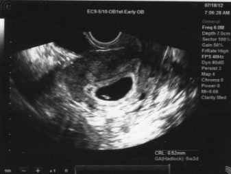 Узд на 4 тижні вагітності (29 фото): чи можна робити, розмір плоду, що видно через 3 тижні після зачаття