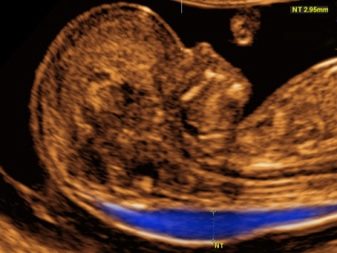 УЗД у 2 му триместрі вагітності (33 фото): на якому терміні роблять другий скринінг і як часто можна проводити УЗД, норма показників