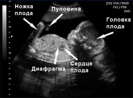 УЗД у 2 му триместрі вагітності (33 фото): на якому терміні роблять другий скринінг і як часто можна проводити УЗД, норма показників