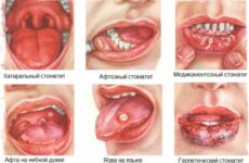 Заживляющая мазь для порожнини рота: особливості, різновиди та застосування