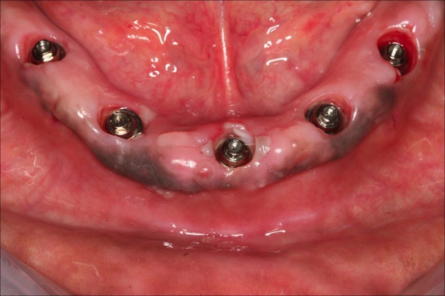 Імплантація зубів   види імплантації, ускладнення і протипоказання