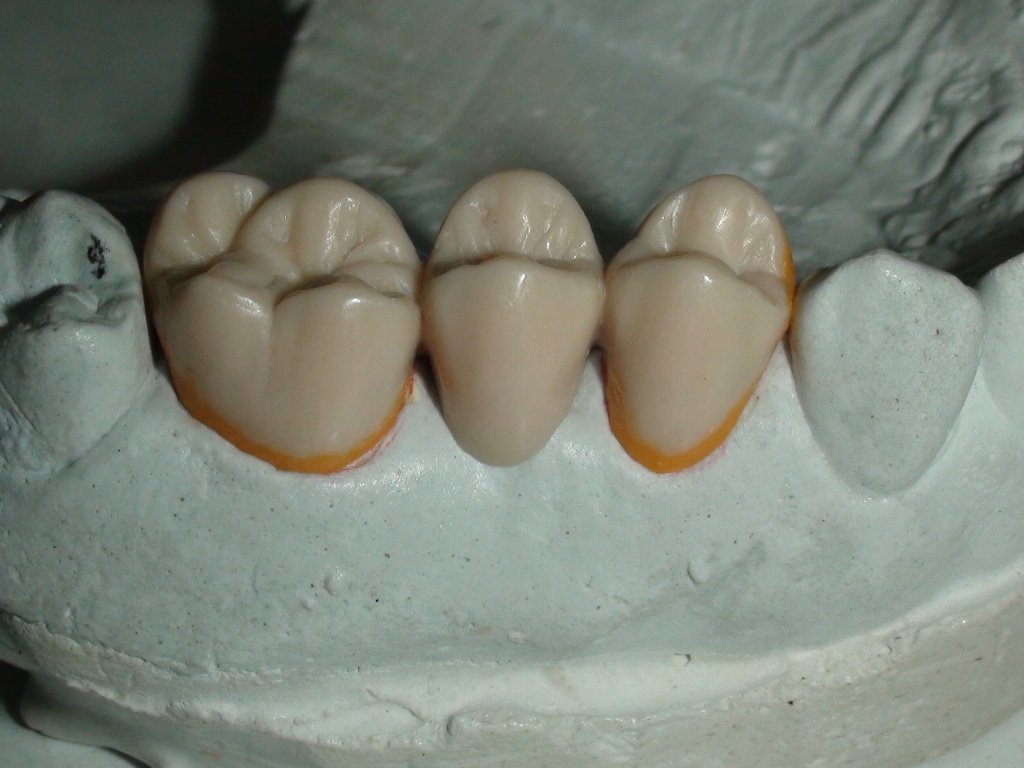 Які зубні протези краще поставити: поради фахівців