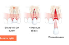 Травми зубів – класифікація, симптоми і методи ефективного лікування