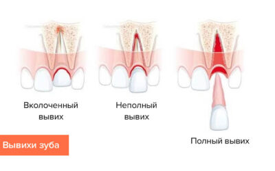 Травми зубів – класифікація, симптоми і методи ефективного лікування