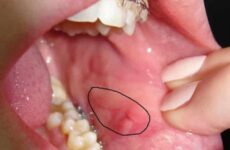 Виразка в роті на щоці: причини виникнення, діагностика і методи лікування