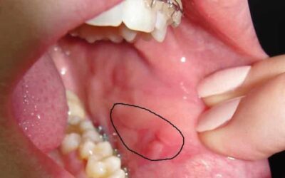 Виразка в роті на щоці: причини виникнення, діагностика і методи лікування