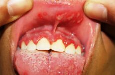 Виразки в роті: причини виникнення та способи лікування в домашніх умовах