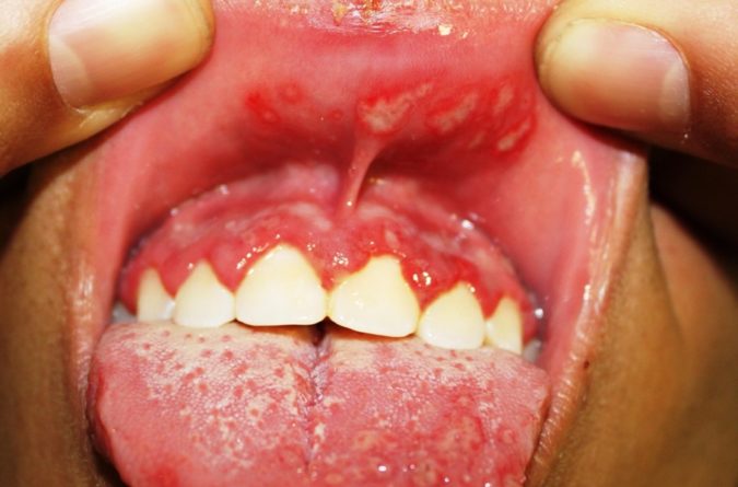 Виразки в роті: причини виникнення та способи лікування в домашніх умовах