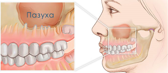 Перфорація гайморової пазухи при видаленні зуба: причини та способи лікування