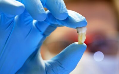 Показання до видалення зуба – коли виникає необхідність видалення