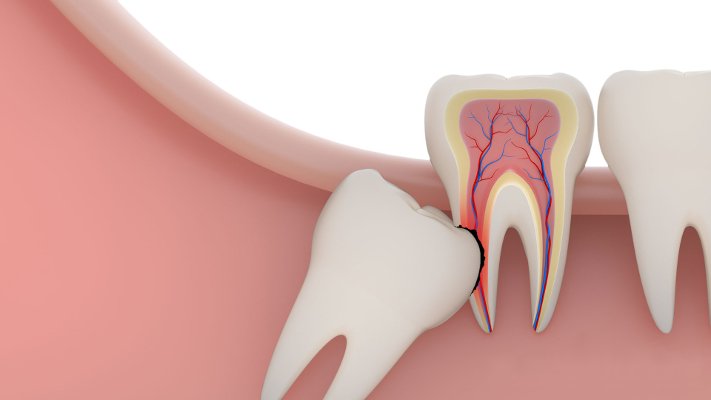 Видалення зубів під загальним наркозом: відгуки пацієнтів