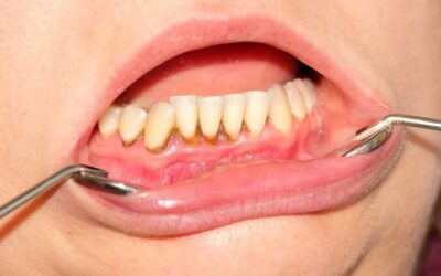 Чим небезпечний зубний камінь: причини появи та методи боротьби з ним