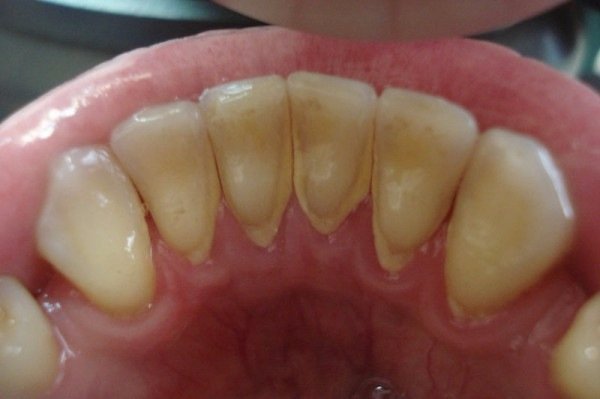 Зубний камінь: причини виникнення, профілактика і способи видалення зубного каменю
