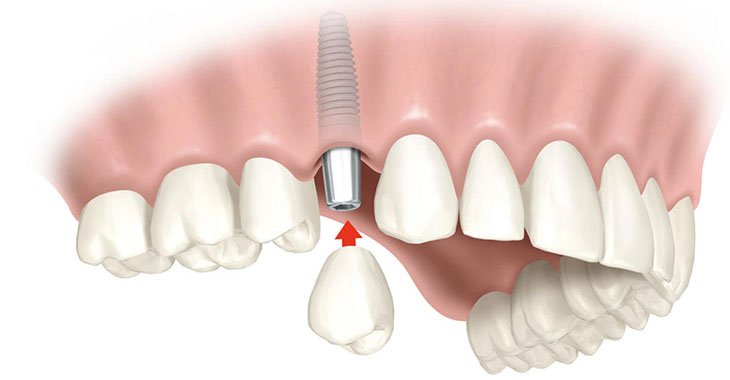 Встановлення імпланта після видалення зуба: коли можна ставити?