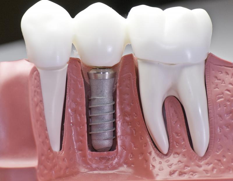 Як довго приживаються зубні імпланти: процес відновлення тканин