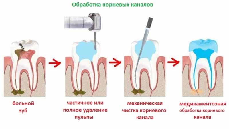 Скільки каналів знаходиться в нижніх і верхніх зубах, від чого залежить їх кількість