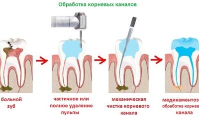 Видалення нерва зуба – причини і методи проведення процедури