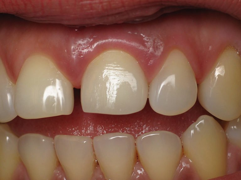 Чому німіють зуби: причини, методи лікування та профілактики