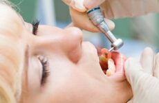 Що таке сепарація зубів – переваги і недоліки процедури