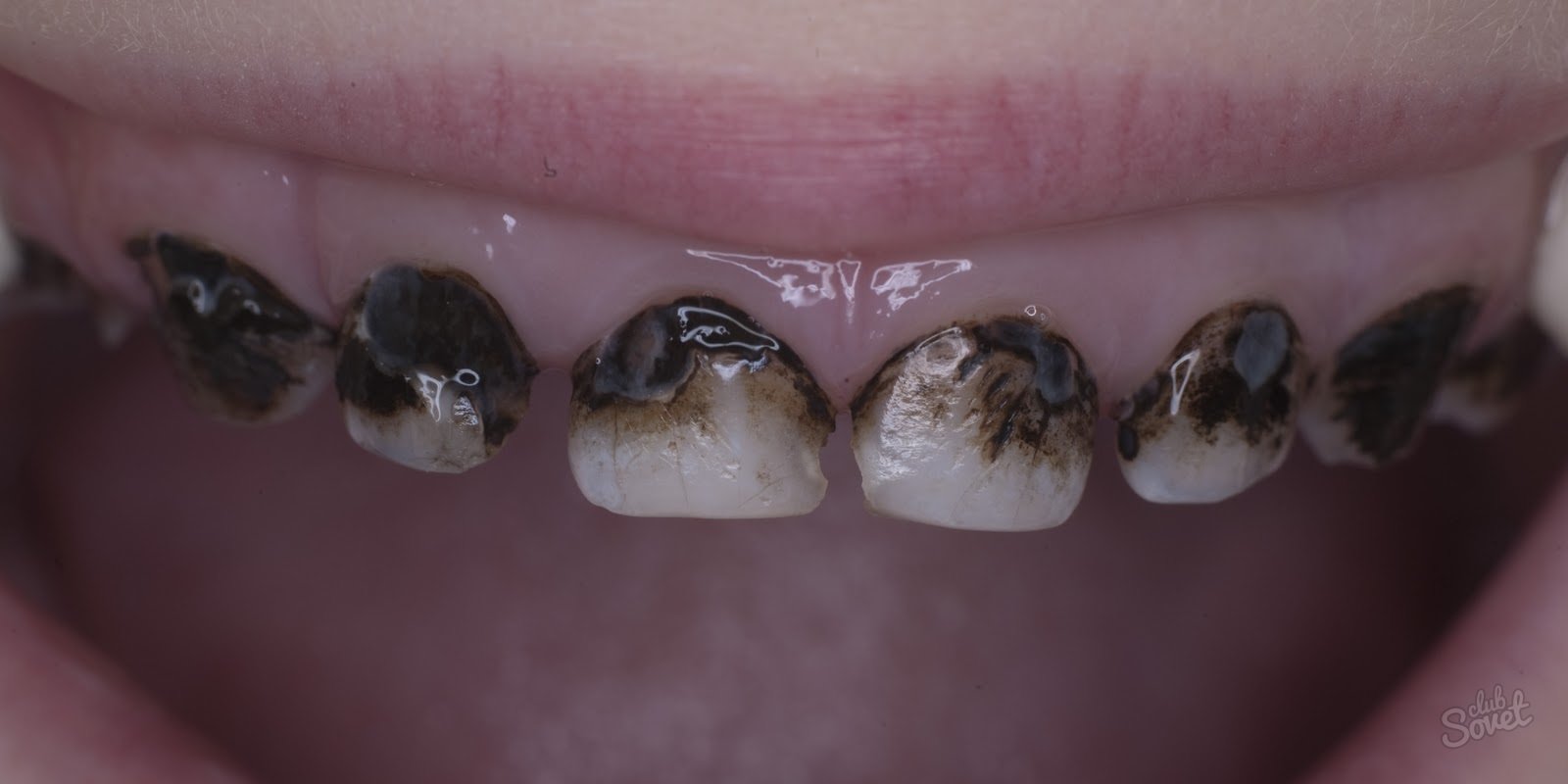 Сріблення зубів у дітей   переваги і недоліки методу