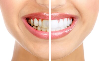 Чому псуються зуби – причини і методи зміцнення