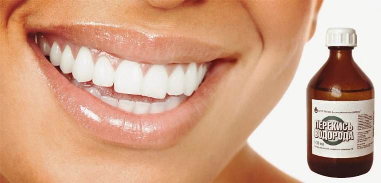 Як відбілити зуби перекисом водню: способи, шкода й користь
