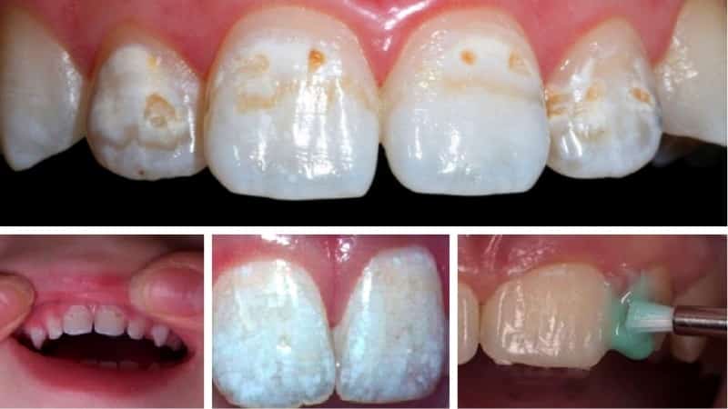 Що таке фторування зубів у дітей: мета і сутність проведення процедури