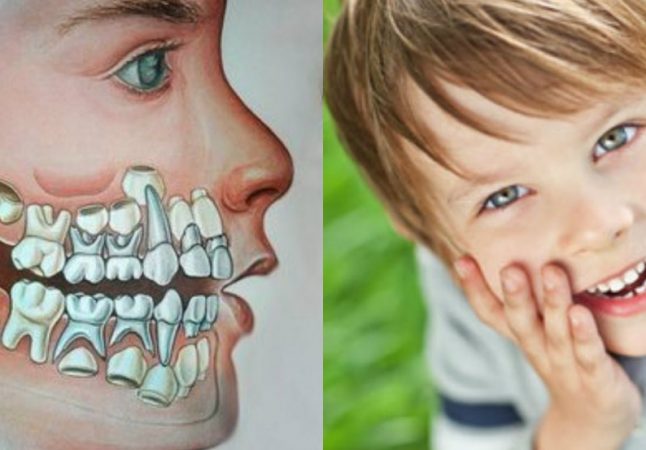 Чому не випадають молочні зуби у дитини: причини