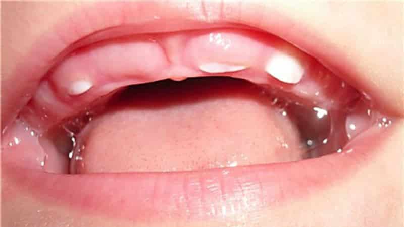 Скільки повинно бути зубів у дитини в 1 рік: точна кількість і терміни прорізування