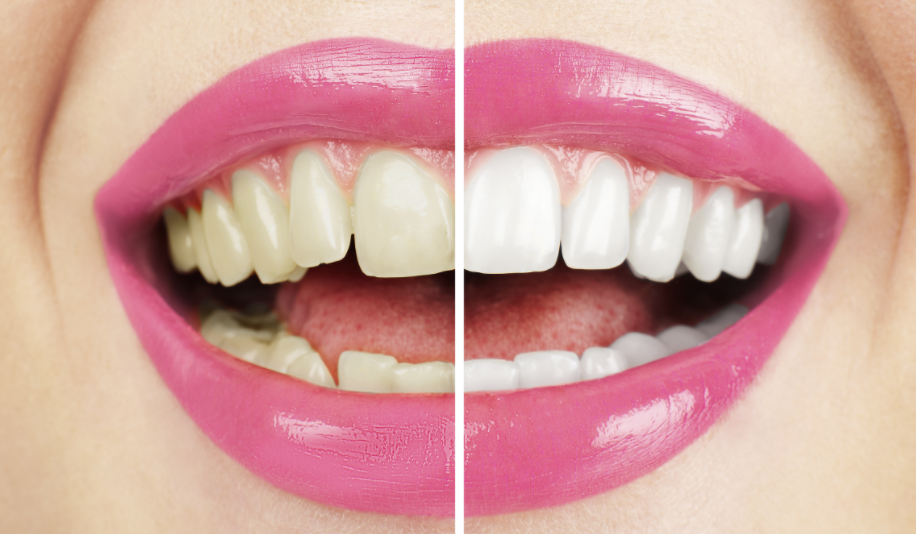 Чим відбілити зуби в домашніх умовах: кращі методи і засоби