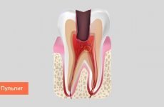 Болить зуб після лікування пульпіту: причини і що робити?