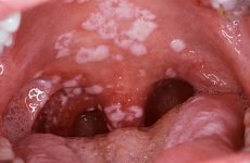 У роті дитини білий наліт: причини виникнення та методи лікування