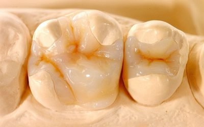 Мікропротезування зубів: показання та протипоказання, етапи процедури