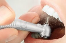 Боляче ставити пломбу на зуб: етапи встановлення і відгуки
