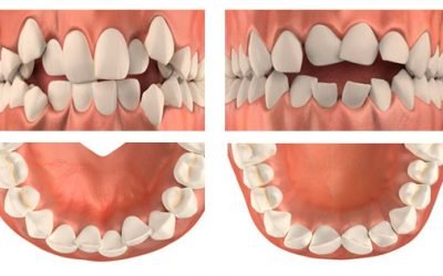 Скупченість зубів: причини патології та методи лікування