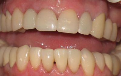 Коронки на передні зуби: основні різновиди, аспекти вибору