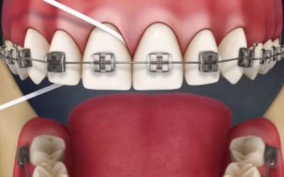 Як користуватися зубною ниткою при брекетах: правила очищення і гігієни