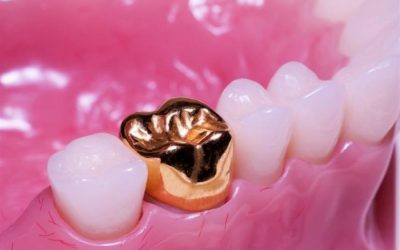 Як ставлять коронку на зуб: етапи встановлення і виготовлення